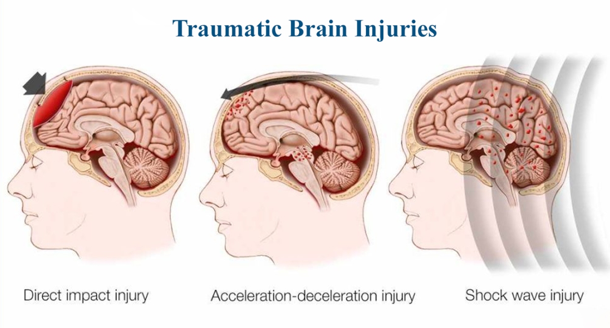 Traumatic Brain Injuries: Everything You Need To Know